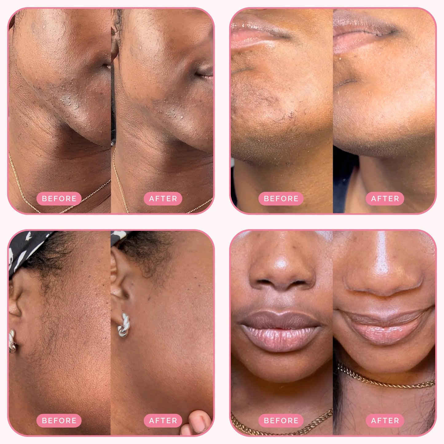 PureSkin